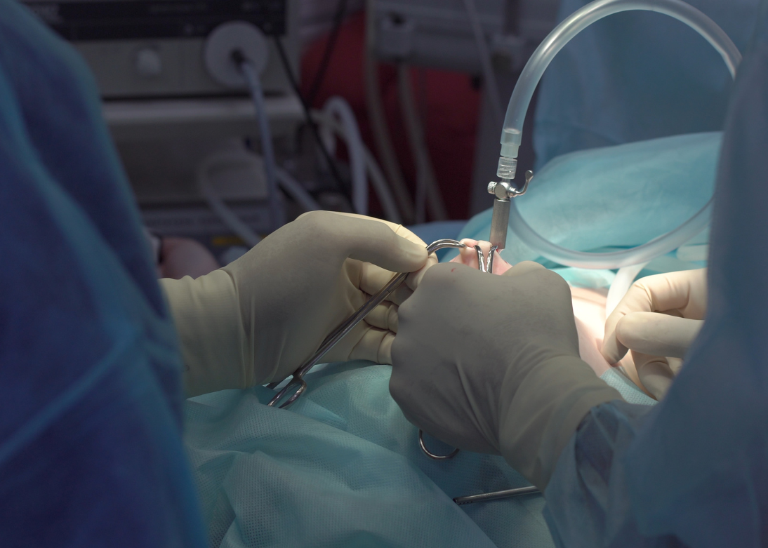 Laparoscopic Surgeries