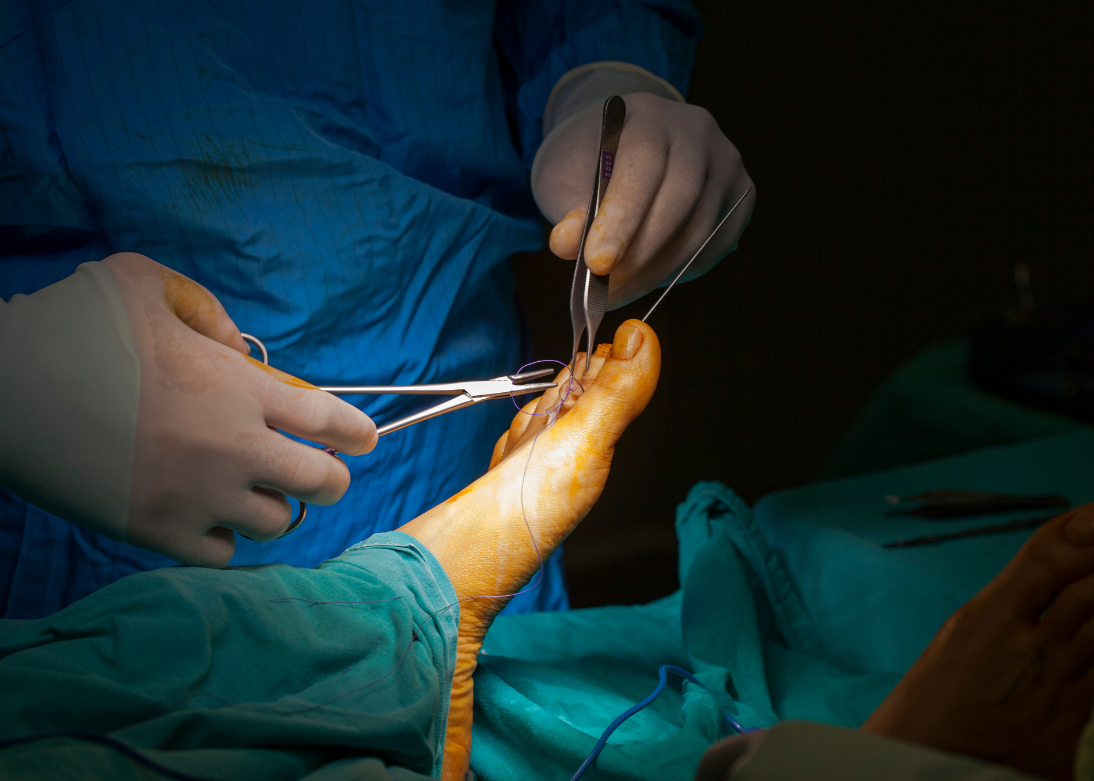 Diabetic Foot Surgeries